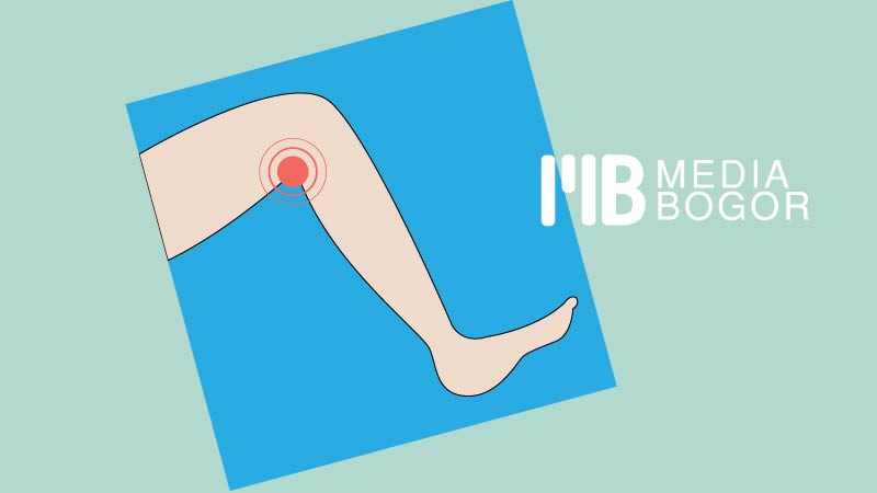 5 Tips Gaya Hidup Sehat Cegah Varises