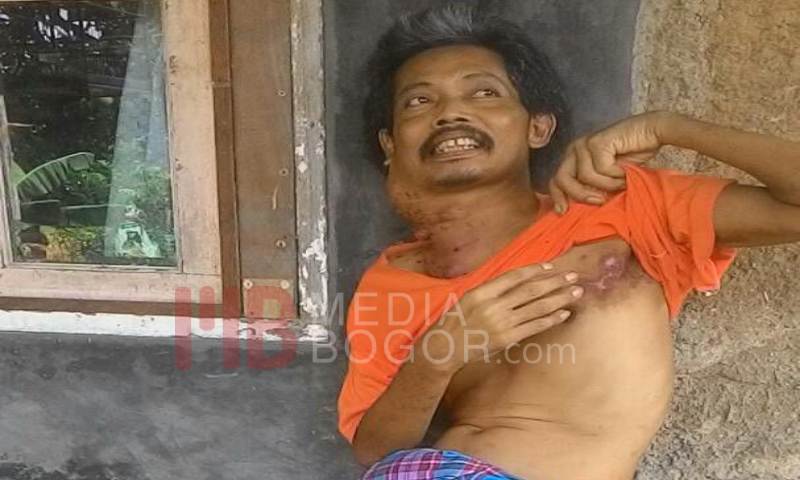 Ini Kisah Ibut, Menahan Rasa Sakit Selama Setahun Karena Benjolan